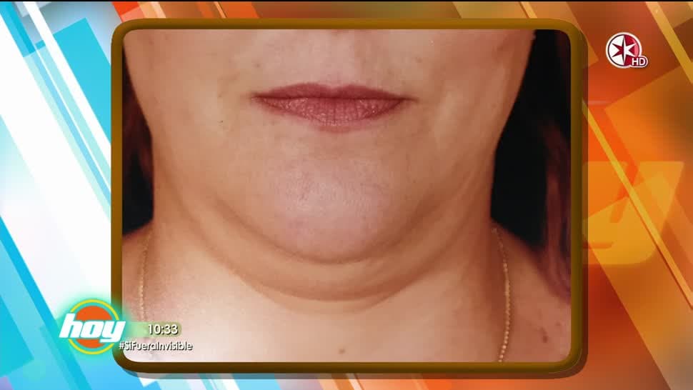 El Dr. Ary Papadópulos comparte opciones para eliminar ‘la papada’